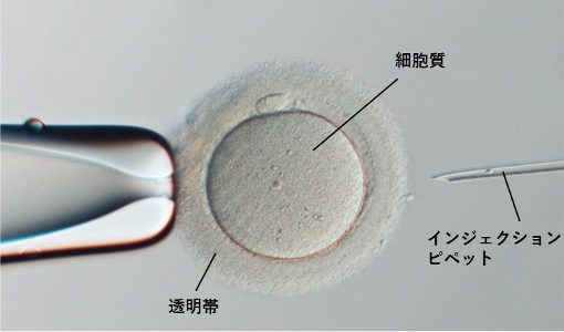従来のICSI