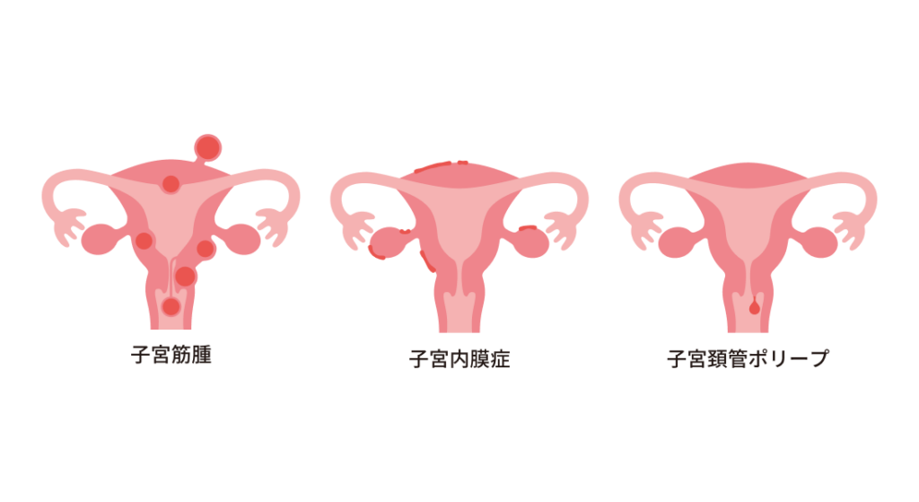 子宮筋腫 子宮内膜症　子宮頸管ポリープ