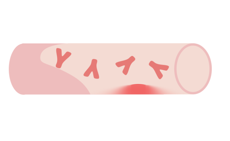 β2GPIネオセルフ抗体